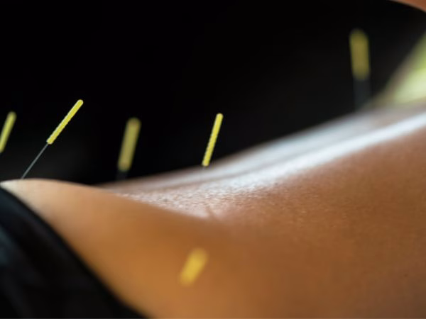 Acupuntura para tratar la ansiedad: Herramienta efectiva y natural