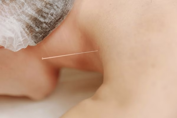 Dolor crónico: Cómo la acupuntura puede ayudarte a recuperar tu movilidad